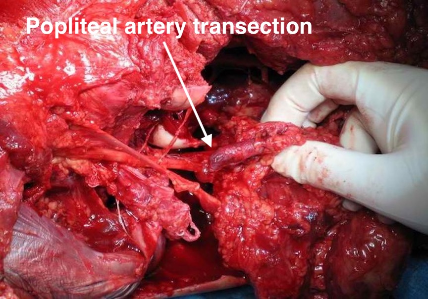 Popliteal artery transection 2
